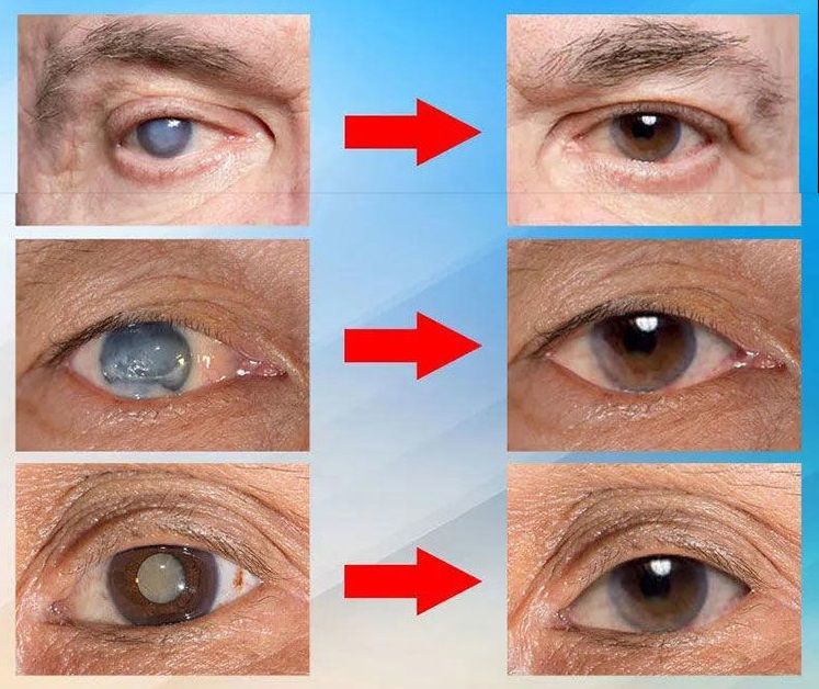 Clinclii Japan Vision Drops — Rapidly Heals All Eye Conditions & Restores Vision